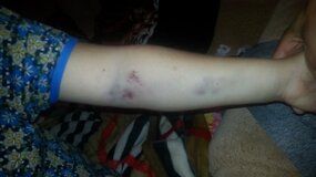 Жалоба-отзыв: ГКП Капчагайская городская больница - Рука опухло и синяки от системы
